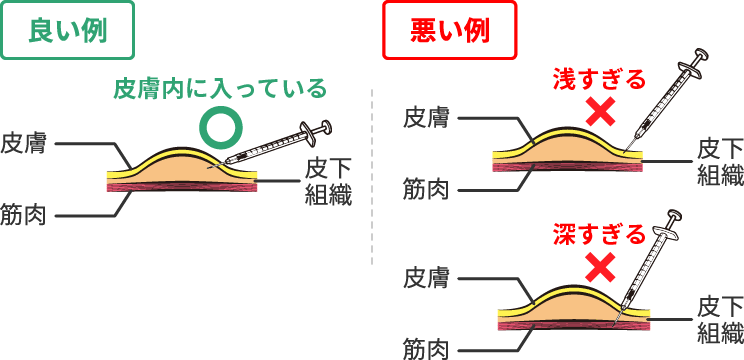 画像:良い例:針先が皮膚内(皮下組織)に入っている、悪い例:浅すぎて皮下組織に届いていない、深すぎて筋肉に刺さっている