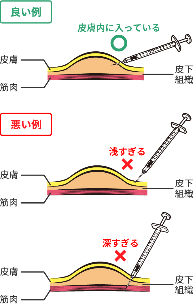 画像:良い例：針先が皮膚内（皮下組織）に入っている、悪い例：浅すぎて皮下組織に届いていない、深すぎて筋肉に刺さっている